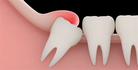 Yirmilik diş sorunlarına karşı dikkat Bu belirtiler dişlerinizin çekilmesine neden olabilir
